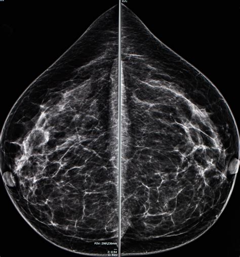 leesburg breast cancer mammogram images|Women’s Health .